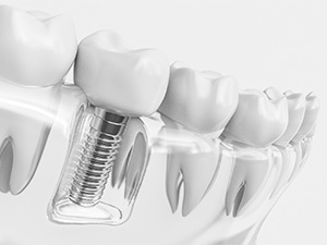 Dental implant in a plastic model of mouth