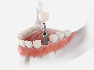 Dental implant and crown being inserted into jaw