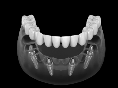 Illustration of full arch dental implants for lower arch
