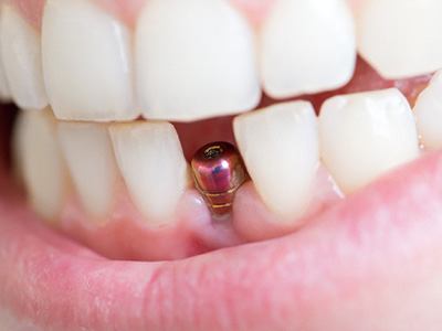 A dental implant abutment
