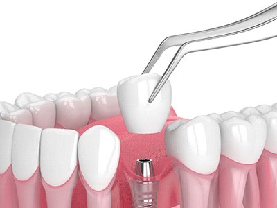 A 3D illustration of a dental implant restoration
