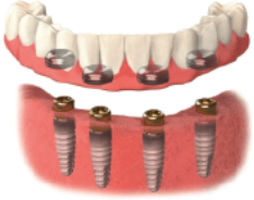 Illustration of four dental implants and dentures