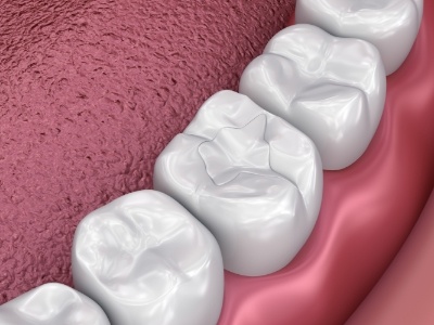 Close up of animated row of teeth with dental sealants