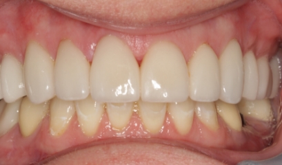 Close up of flawless teeth after getting veneers