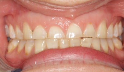 Close up of imperfect teeth before getting veneers from Encinitas dentist
