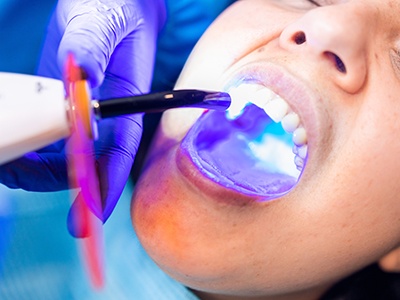 a patient having a tooth bonded