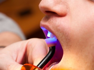 Close up of dental patient receiving direct bonding on their tooth