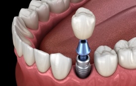 Animated dental implant with dental crown