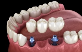 Two animated dental implants with a dental bridge