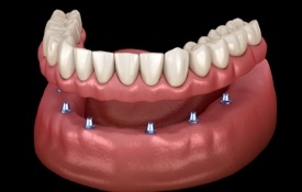 Six animated dental implants with a full implant denture