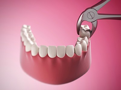 Illustration of tooth being removed