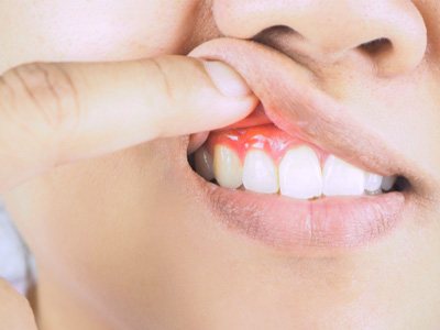 Closeup of a person with gum disease