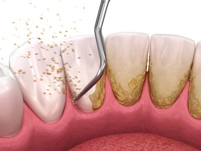 Digital illustration of scaling and root planing