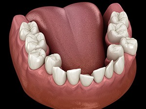 Illustration of crooked teeth