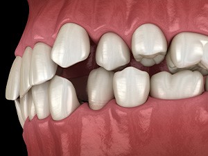 Illustration of gapped teeth