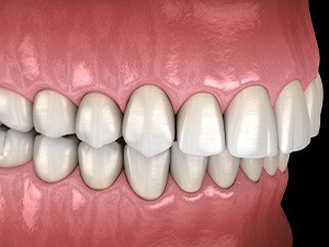 Illustration of an overbite