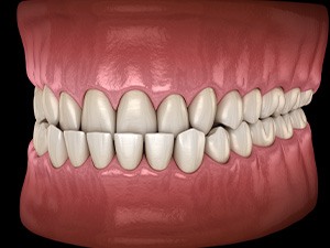 Illustration of an underbite