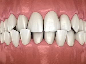 Illustration of a crossbite