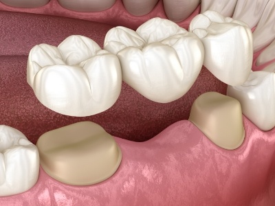 Animated dental bridge replacing a missing tooth