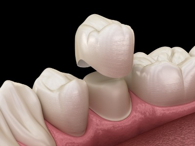 Animated dental crown being placed over a tooth
