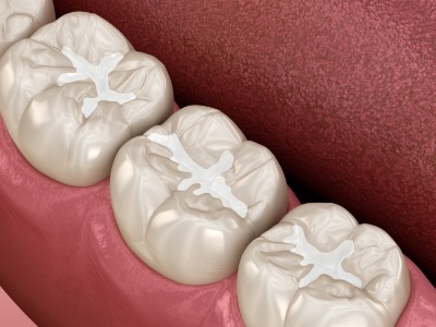 Animated row of teeth with tooth colored fillings