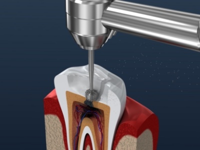 Animated dental instrument cleaning out the inside of a tooth during root canal treatment