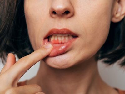 Lady shows gum inflammation