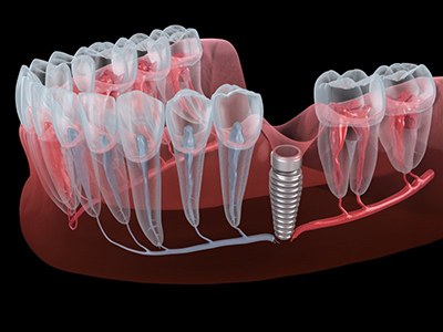 Illustration of troubled dental implant
