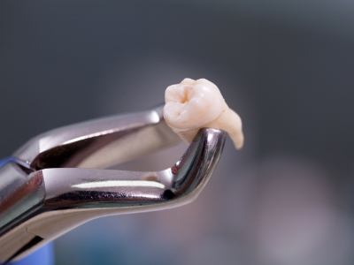 Dental forceps holding a tooth after a tooth extraction