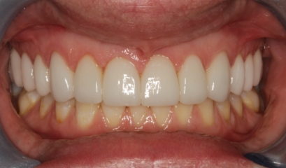 Close up of flawless teeth after getting veneers