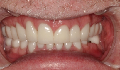 Close up of flawless teeth after getting veneers