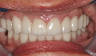 Close up of flawless teeth after getting veneers