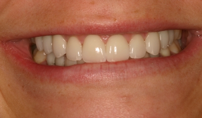 Close up of flawless teeth after getting veneers