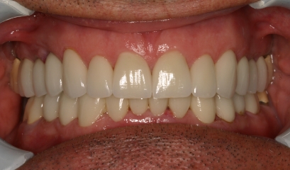 Close up of flawless teeth after getting veneers