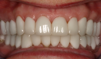 Close up of flawless teeth after getting veneers