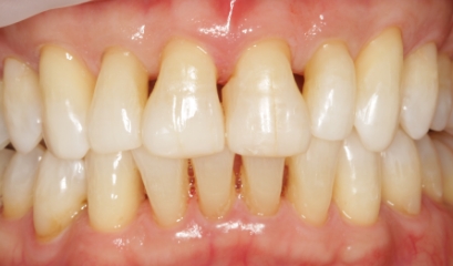 Close up of flawless teeth after getting veneers