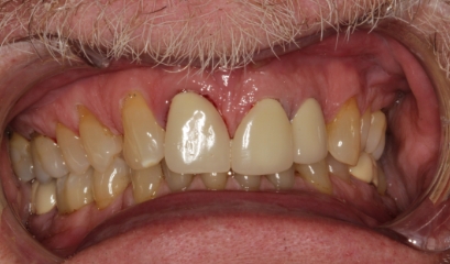 Close up of imperfect teeth before getting veneers