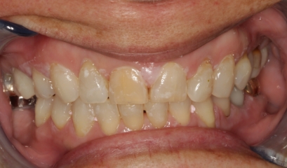 Close up of imperfect teeth before getting veneers