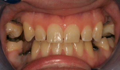 Close up of imperfect teeth before getting veneers