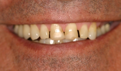 Close up of imperfect teeth before getting veneers