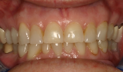 Close up of imperfect teeth before getting veneers