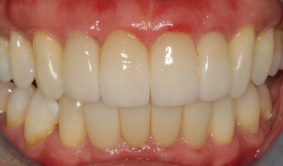 Close up of imperfect teeth before getting veneers