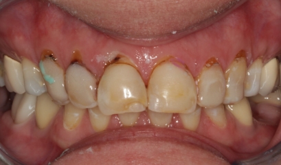 Close up of imperfect teeth before getting veneers