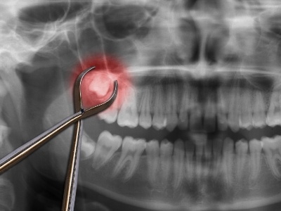 Dental forceps over x ray of teeth with wisdom teeth highlighted red
