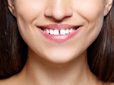 Close up of woman smiling with gap between front teeth