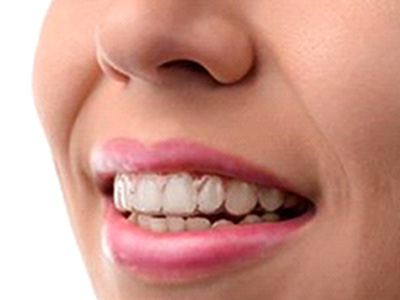 Close up of person wearing Invisalign over teeth