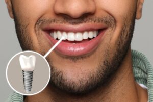 Man smiling with dental implant