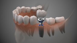 Dental implant. 